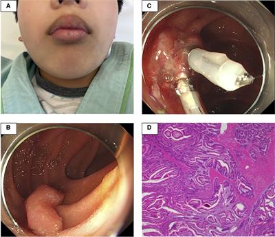 Gastrointestinal bleeding after endoscopic mucosal resection in a case of Peutz–Jeghers syndrome with hypofibrinogenemia: A case report